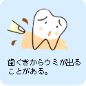 歯ぐきからウミが出ることがある。