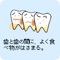歯と歯の間に、よく食べ物がはさまる。